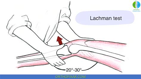 lochman compression test|lachman test.